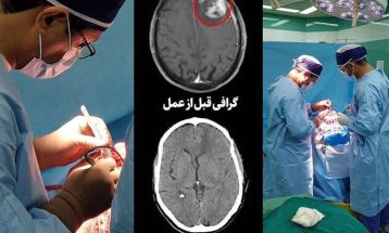 جراحی موفق تومور بزرگ مغزی در گناباد